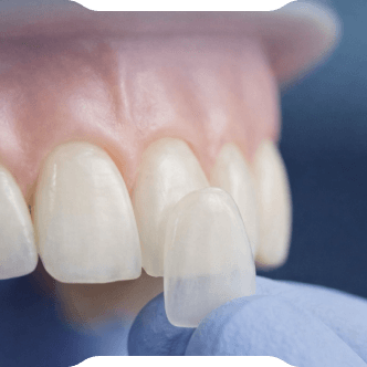 Perfect Aesthetics Without Tooth Preparation:<br/> Natural and White Smiles with Laminate Veneers