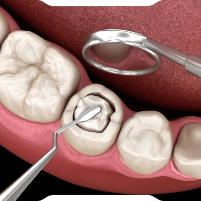 Kompozit Dolgu (Estetik Beyaz Dolgu)