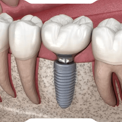 Dental İmplant