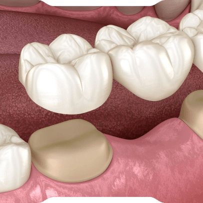 Sabit Protez Uygulamaları