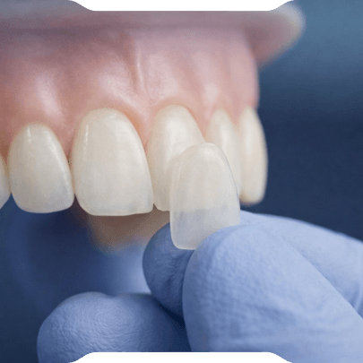 Laminate Veneer (Yaprak Porselen)