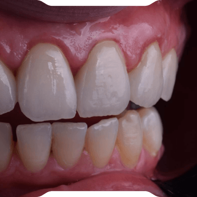 Zirkonyum Kaplamalar